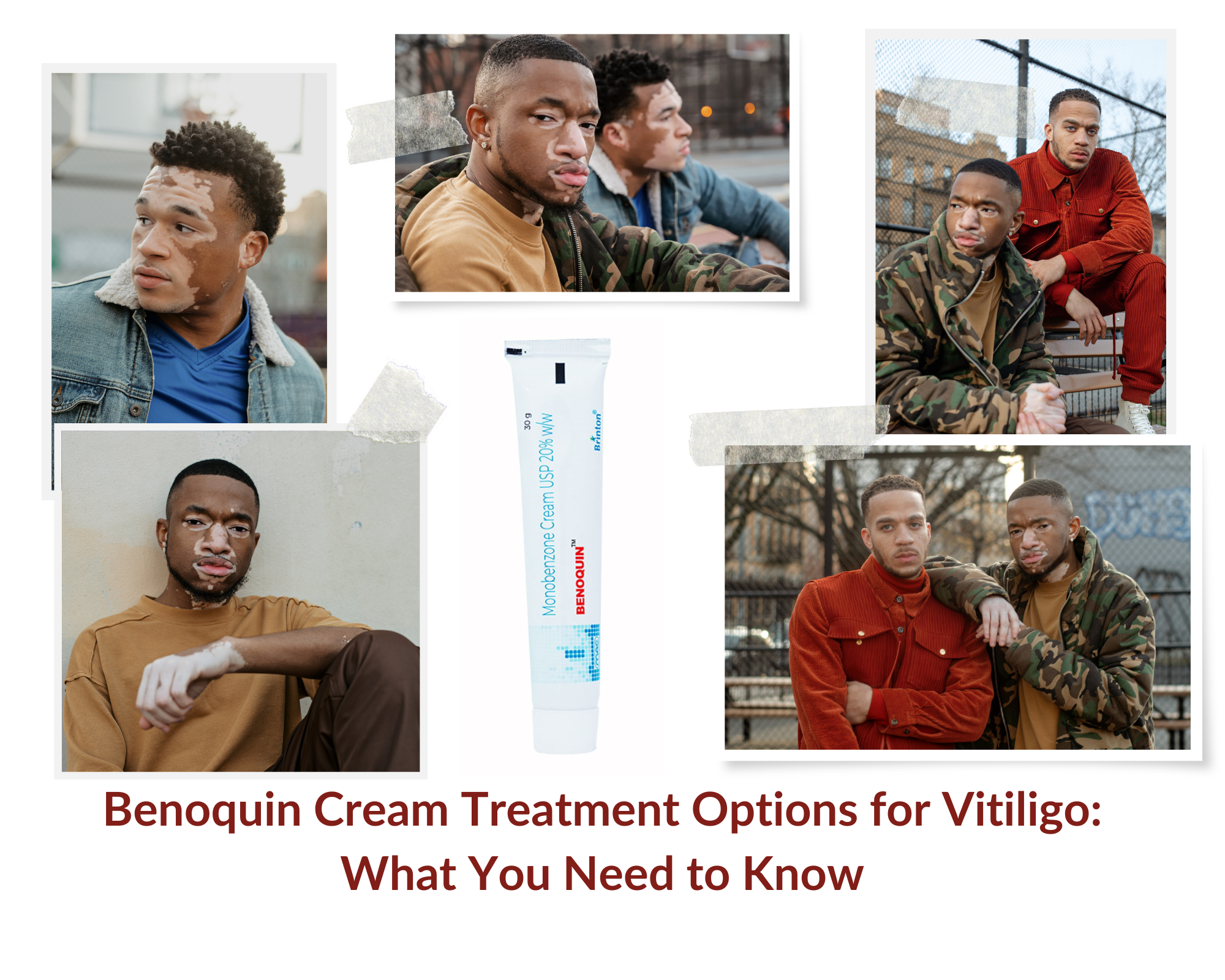  Benoquin Cream Treatment Options for Vitiligo: What You Need to Know